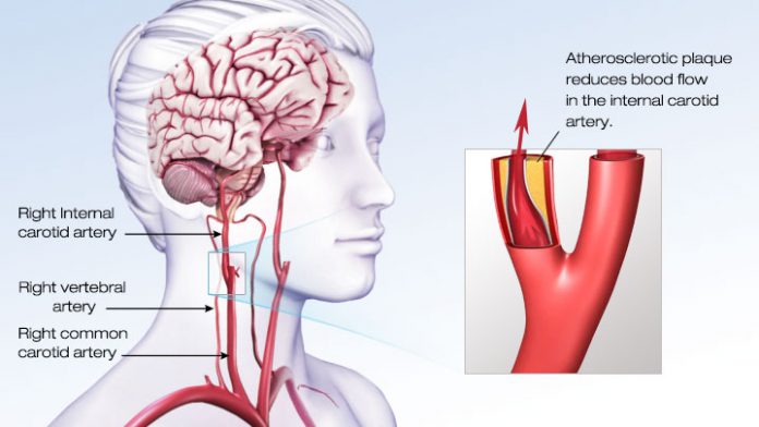 stroke affecting right side